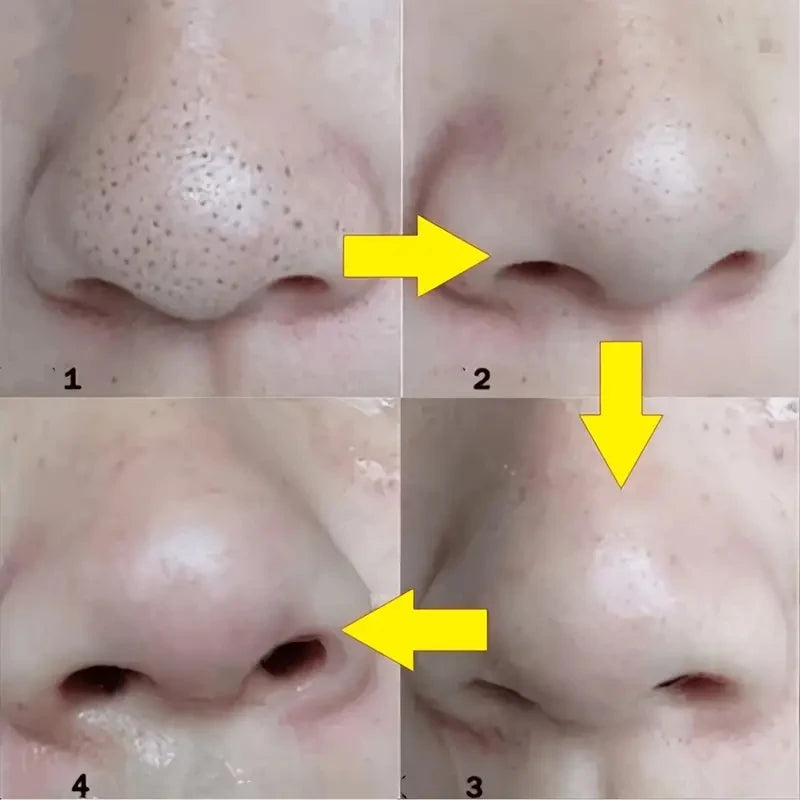 Nose Blackhead Remove Mask Plaster